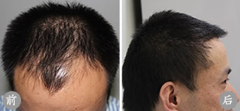 杭州格莱美植发案例 男性III级脱发患者成功手术