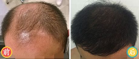 济南碧莲盛植发为男性6级脱发患者植发效果
