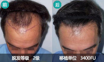 重庆迪邦男性植发真实案例 成功摆脱M字型发际线