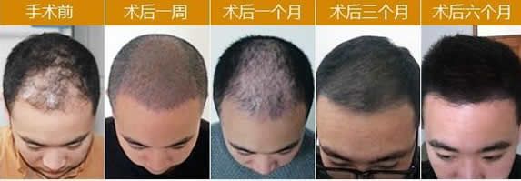 北京八大处毛发移植案例图