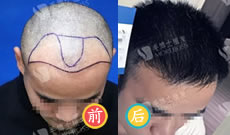 30岁叶先生在毛博士种植3500毛囊告别大M型脱发形象