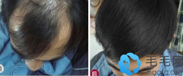杭州新生毛发移植效果对比图