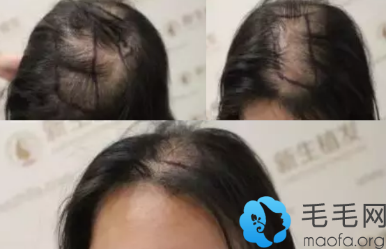 女性雄脱去南京新生植发植发前照片