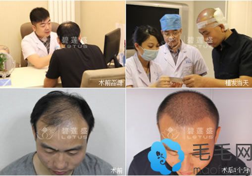 北京碧莲盛植发手术过程