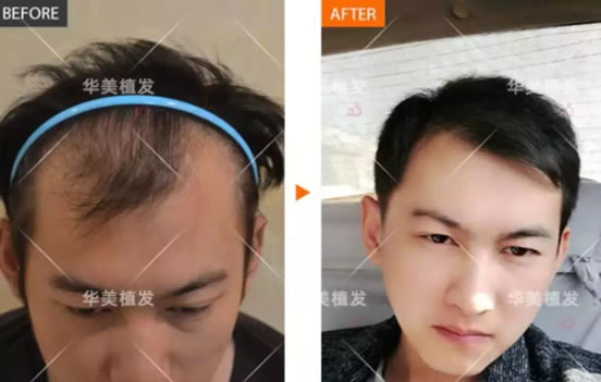 耗时4小时,在武汉华美陈克的帮助下成功植发解救秃顶危机